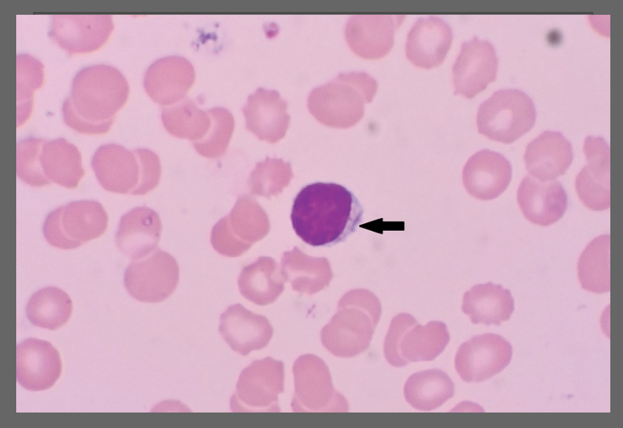 feldstej's tweet photo. #auerrods ?blast ?lymphocyte ?plasma cell

Gupta A, et al. Pediatr Blood Cancer. 2017. https://t.co/lDJaEV9TCn