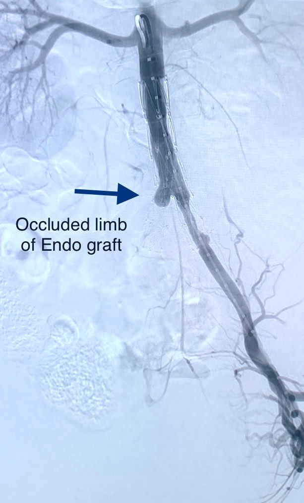 t_intheleadcoat's tweet photo. #acutelimbischemia due to #limbthrombosis of #AFX placed months ago to exclude #aorticclot and #iliac clot causing #limbthreatening ischemia. Stopped taking #Coumadin due to #vaginalbleeding from #fibroids. #balloonexpandable #coveredstents used. Also #UFE done #radial. #irad https://t.co/g8eI7585NZ