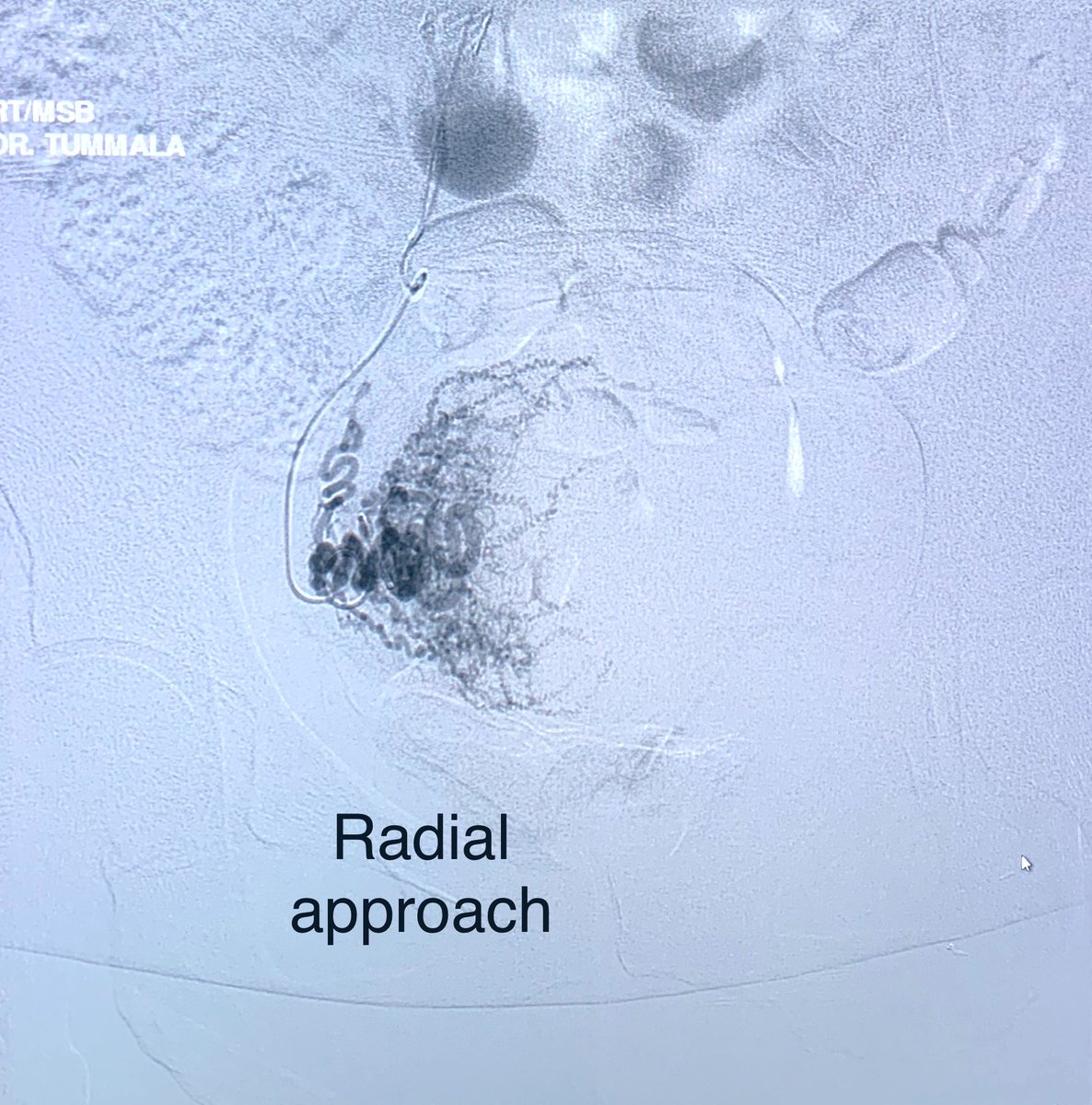 t_intheleadcoat's tweet photo. #acutelimbischemia due to #limbthrombosis of #AFX placed months ago to exclude #aorticclot and #iliac clot causing #limbthreatening ischemia. Stopped taking #Coumadin due to #vaginalbleeding from #fibroids. #balloonexpandable #coveredstents used. Also #UFE done #radial. #irad https://t.co/g8eI7585NZ