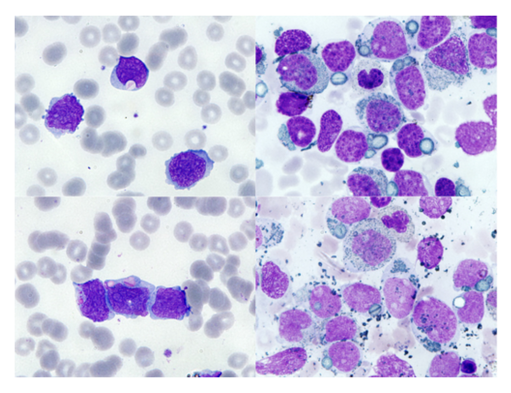 feldstej's tweet photo. #auerrods ?globs ?inclusions ?blasts 

Yin J, et al. Br J Haematol. 2019. https://t.co/iXeLAelhDU