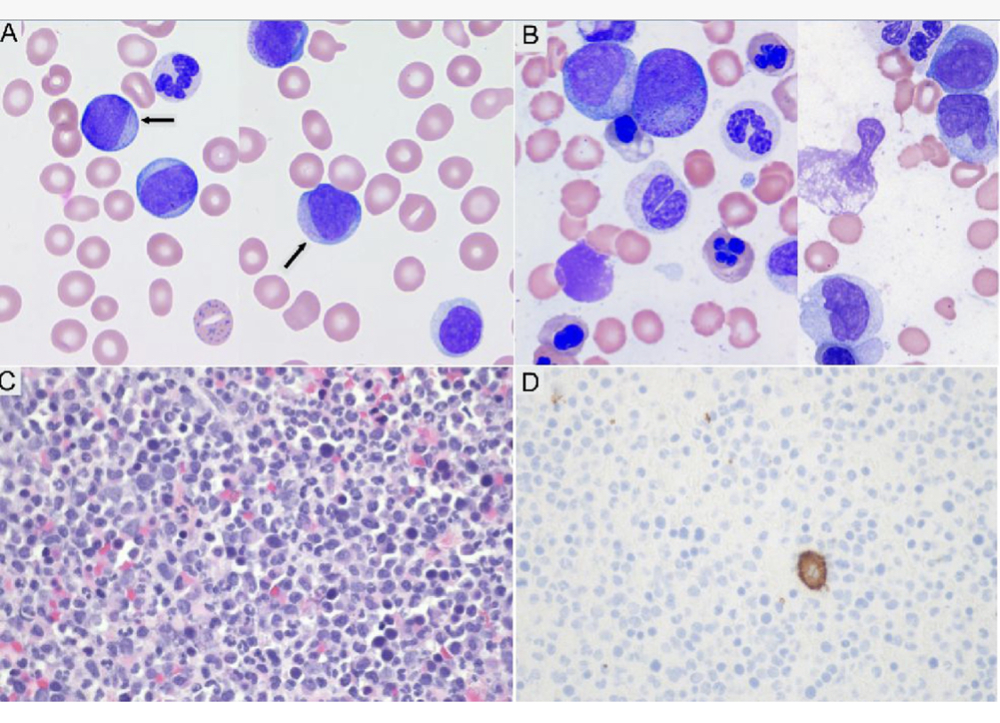 feldstej's tweet photo. #auerrods ?blasts ?dysplasia 

Li W, et al. Pathol Res Pract. 2018. https://t.co/lzHI2vn3p6