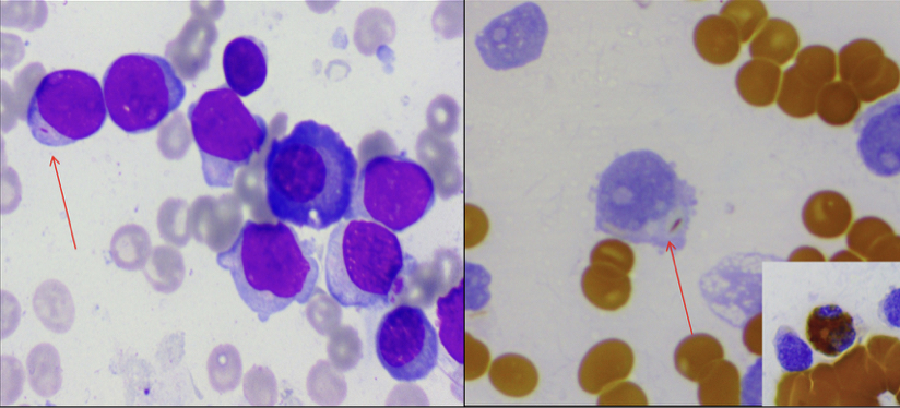 feldstej's tweet photo. #auerrods ?myeloblasts ?lymphoblasts

Rahman K, et al. Int J Lab Hematol. 2019. https://t.co/ACdAXnmgsc