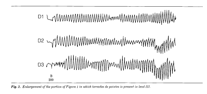 2/ First, let's find how torsades was originally described (and named!):Francois Dessertenne noted "ventricular tachycardia with two variable foci" in a patient in 1966He coined the arrythmia torsades de dointes, connoting "twisting peaks" https://bit.ly/2XN9Hp5 