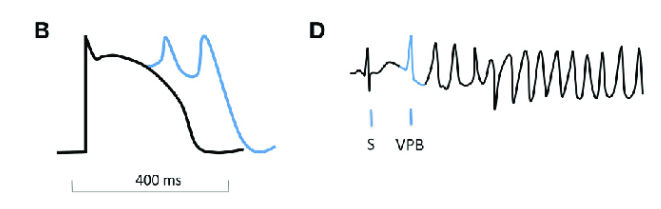 5/Torsades arises from a specific sequence of events that disrupts repolarization.Sinus beatProlonged QTVentricular ectopic beat during depol (aka an "early after depolarization" or EAD, thought to be calcium-mediated)Re-entrant arrythmia https://bit.ly/2ruAj1R 
