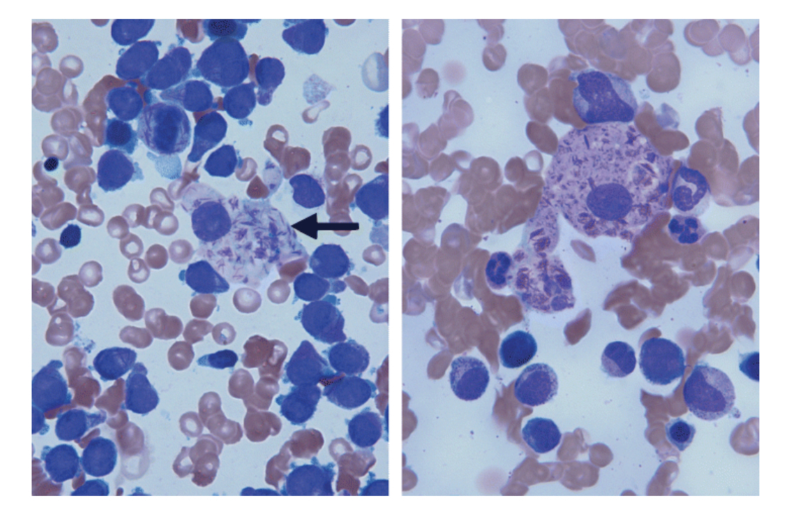 feldstej's tweet photo. #auerrods ?blasts ?macrophages ?HLH 

Brown C, et al. Br J Haematol. 2006. https://t.co/5j0RMJzzfw