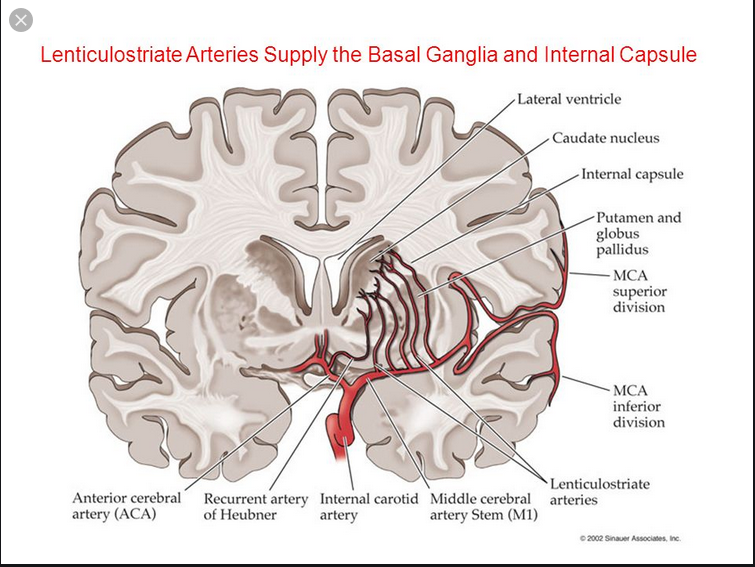 5/9Why the basal ganglia? Mucor, highly angioinvasive. Tissue infarction/necrosis, path hallmarks. https://academic.oup.com/cid/article/45/11/1522/335289Contaminated injection  microvascular injury from injected drug  seeding to highly vascularized area (small penetrating arterioles/collaterals)