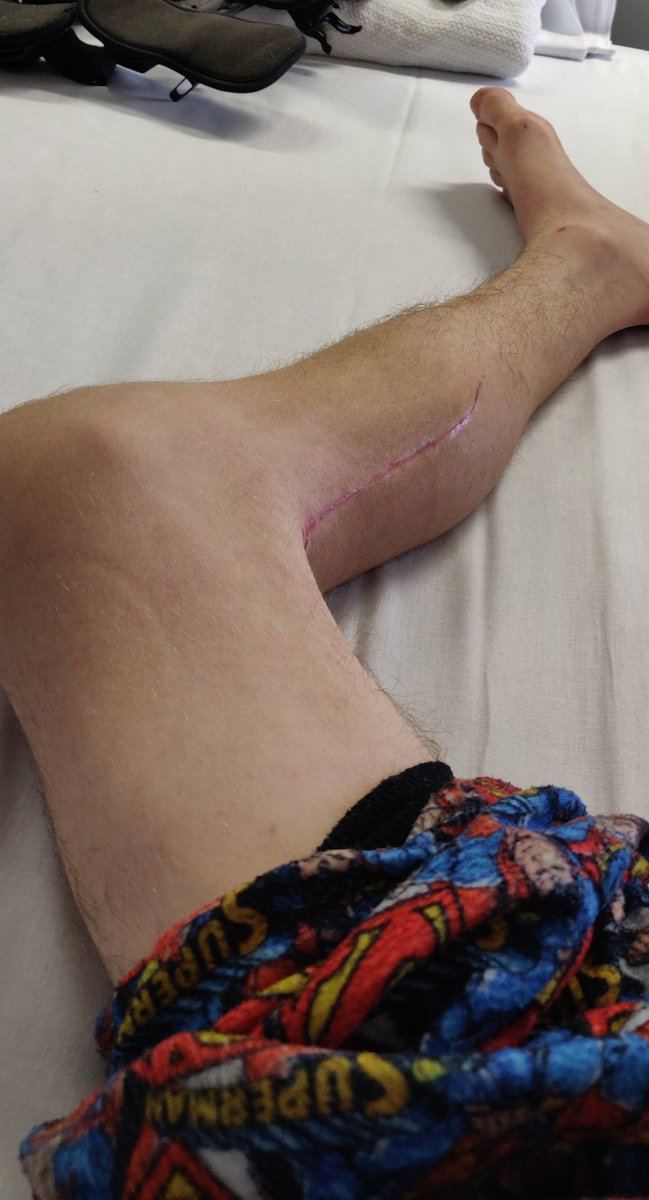 callander_adam's tweet photo. well my leg is fully healed now the scar is motivation for me to keep up the hard work
 #injury #recovery #health #physiotherapy #rehabilitation  #pain #rehab #fitness #accident  #motivationaltuesday #transformationtuesday #gettingovermyself #workingonit #takingitdaybyday https://t.co/Y2ztYYmcPg