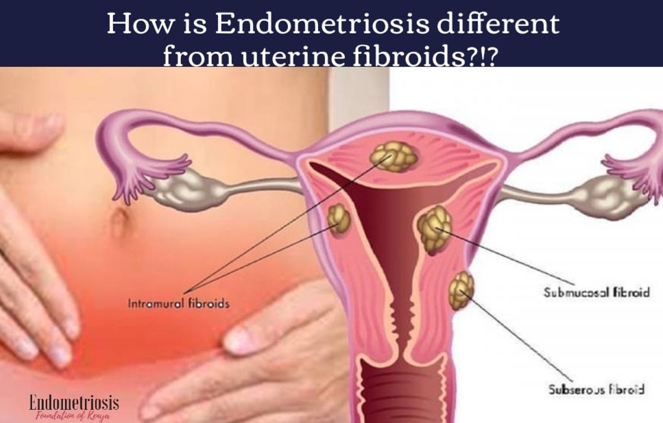 EndoFoundKE's tweet photo. #EndoFacts

How is #Endometriosis different from uterine fibroids?

Uterine fibroids are due to growth of muscle cells in the uterus whereas #Endometriosis is similar to tissue that line the uterus https://t.co/RWDg6vlI70