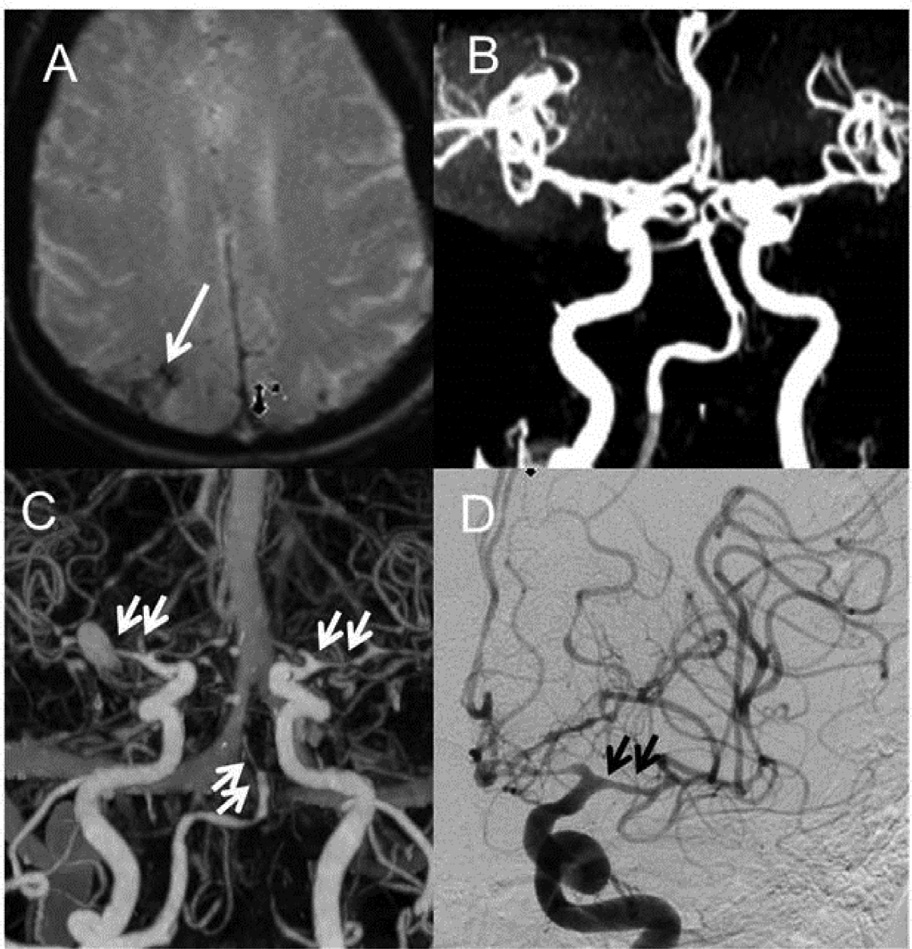 VivienHLee's tweet photo. Our paper on Nontraumatic Convexity #SubarachnoidHemorrhage represents the largest series to date. Journal of Stroke &amp; Cerebrovascular disease lets us share 50 days of free access to the article here: https://t.co/FOthRm6L2O
@bustinclots247 @Stroke_doc @JohnSayona https://t.co/3TMpEN2HDu