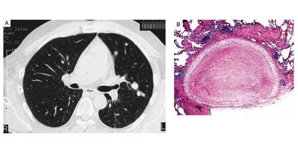 NEJM's tweet photo. From the #NEJMArchive: Pulmonary Cryptococcal Granulomas https://t.co/04cgoadJrP https://t.co/ifXG7xhgJ3