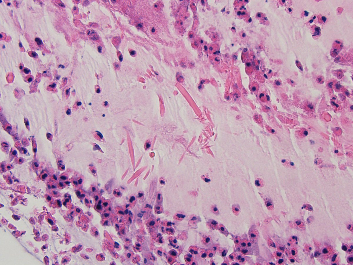 TedFarMD's tweet image. Charcot-Leyden Crystal, lung biopsy in asthmatic patient.
#Pulmonarypath, #pathboards