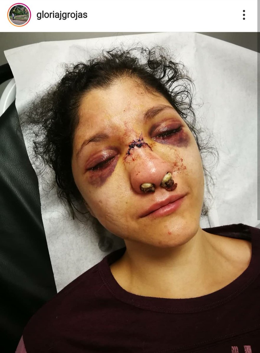 una_geminiana's tweet photo. Violette González, 28 años, repartía agua con bicarbonato a quienes habían sufrido efecto de gases. Recibió golpiza por parte de policías. Por mal diagnóstico quedará con lesión, y quizás no vuelva a respirar por la nariz. Quebraron varios de sus dientes 😔 su mamá cuenta más 👇 https://t.co/QGyUv1rKg1