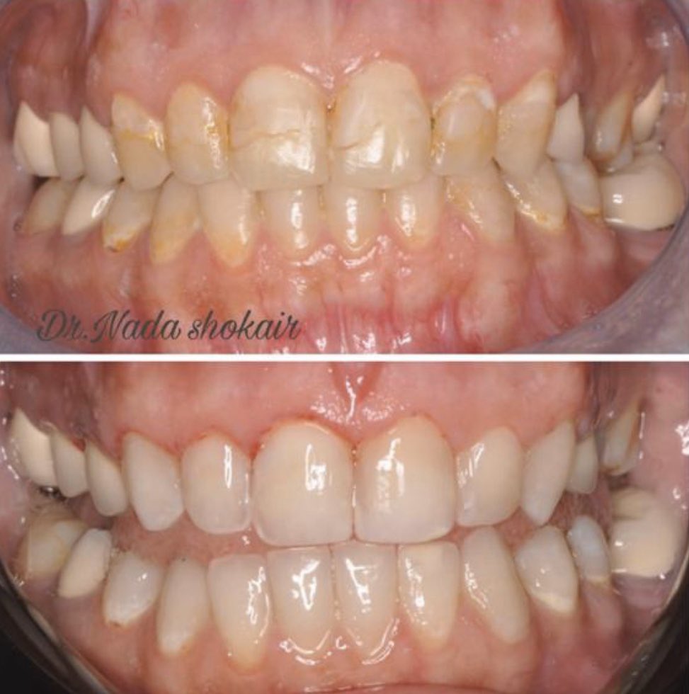 Dentist_List's tweet photo. حاله الدكتوره ندى @dr_NadaShokair ، شوفوا كيف حولت الحاله فقط بتبيض وحشوات 😍 https://t.co/65Xc3Me4ka