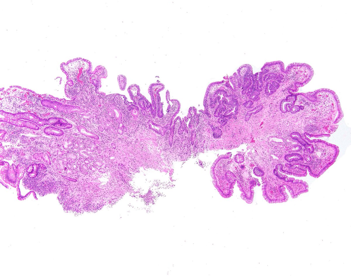 science_press's tweet photo. This is an example of high-grade dysplasia in the ileum in a patient with Crohn's disease. There is a background of pyloric gland metaplasia. There are still copies of our Survival Guide to Gastrointestinal Pathology but they are going fast.  get yours at https://t.co/11aBMJG2Yg https://t.co/2ftxChpDhD
