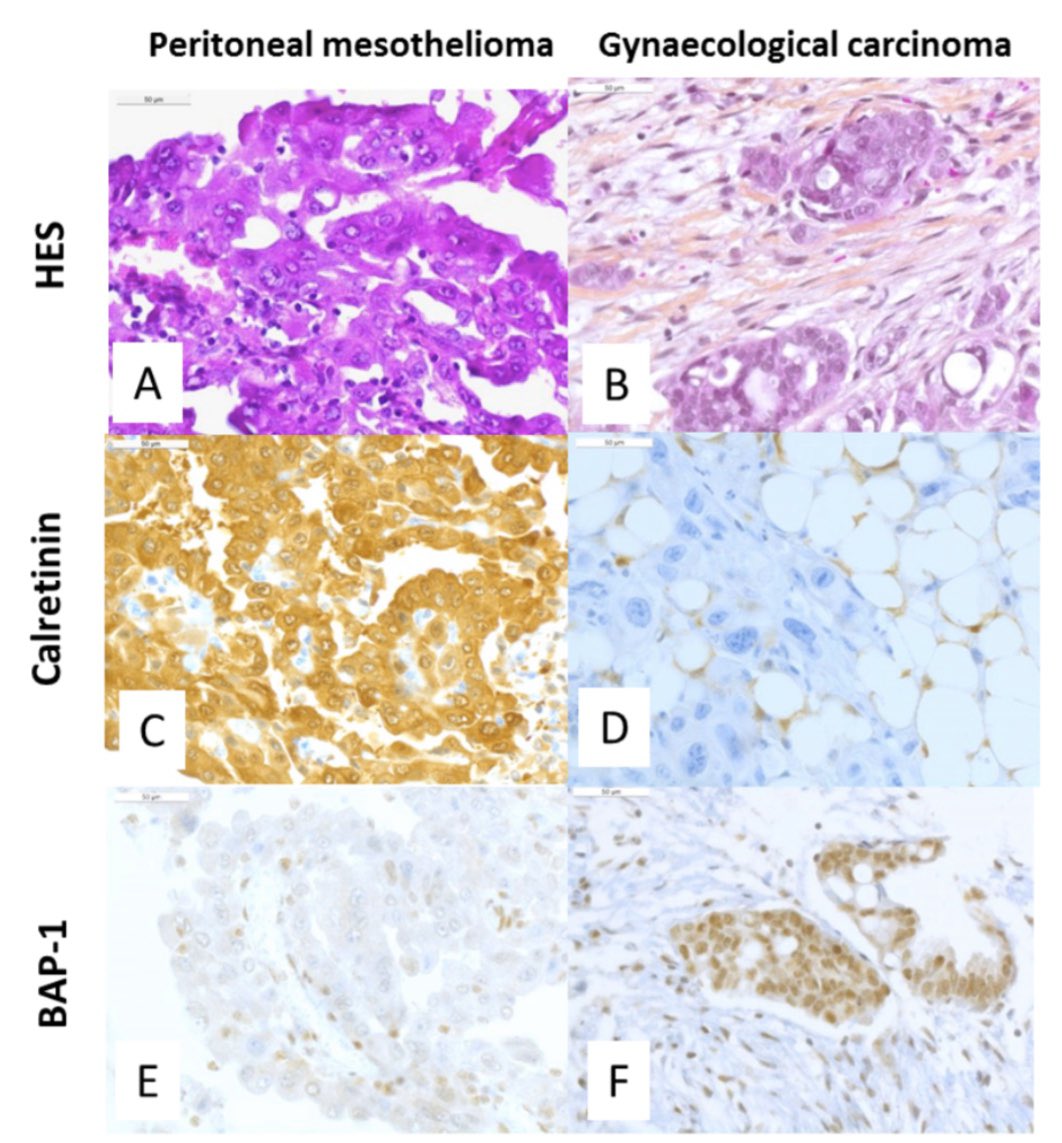 how long can a person live with stage 4 gastric cancer