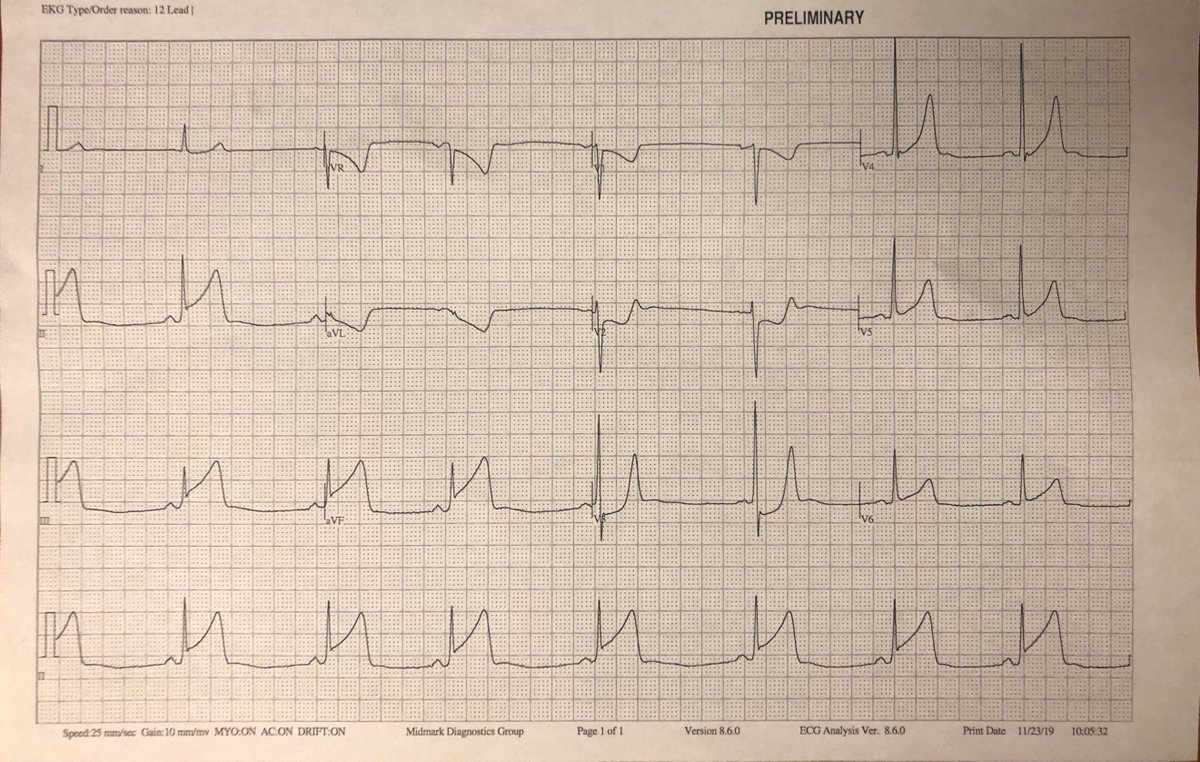 (1/3) Here are a few STEMI-mimics ECG I encountered this month. All with normal coronaries  #radialfirst. 31 year old with abdominal pain and vomiting. Normal coronaries. Final diagnosis Takotsubo.