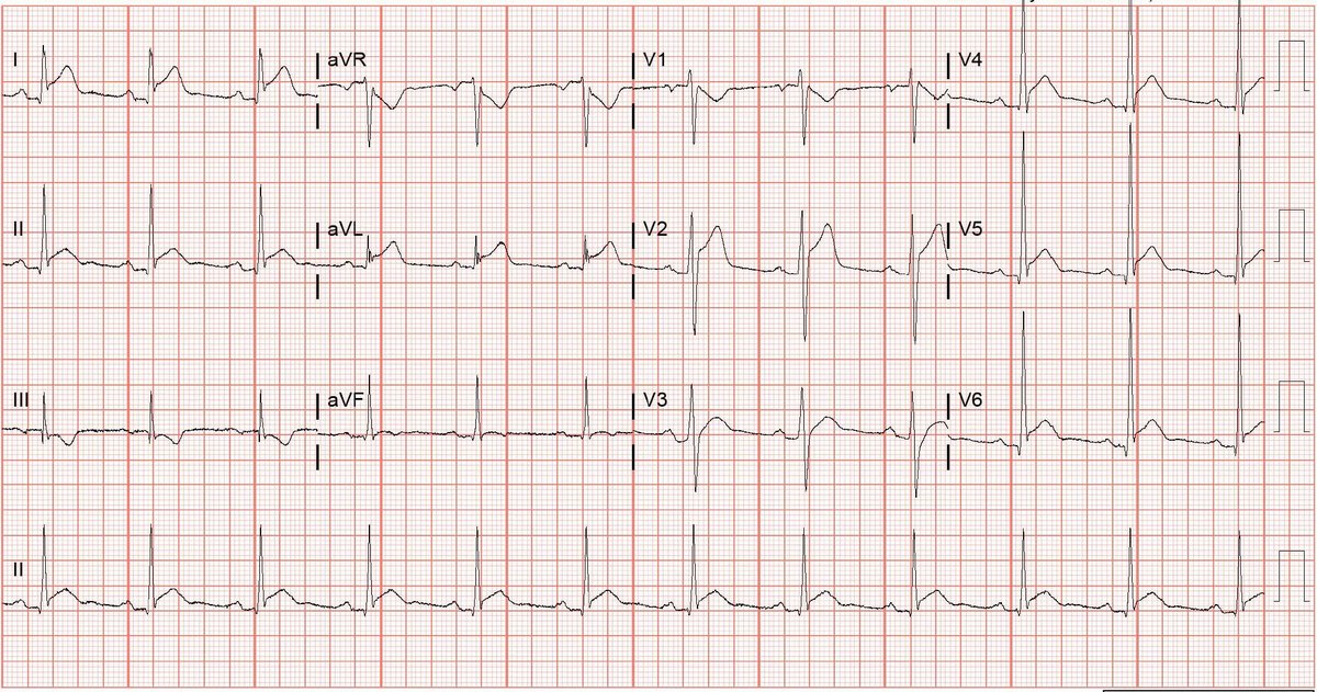 (1/3) This ECG is the most obvious for pericarditis. But it was a 60 year old man with hypertension and hyperlipidemia who has chest pain so I wasn't going to take a risk.