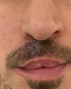 raedenman_'s tweet photo. Are you a male that is concerned with some aspect of your appearance? Are you a male and nervous or unsure of walking into a clinic?

https://t.co/aElsMmwVE0

#visibledifferences #portwinestain #skingraft #medicaltattooing #medicaltattooist #scars #scarring #surreyclinic https://t.co/JZF2ss9LI4