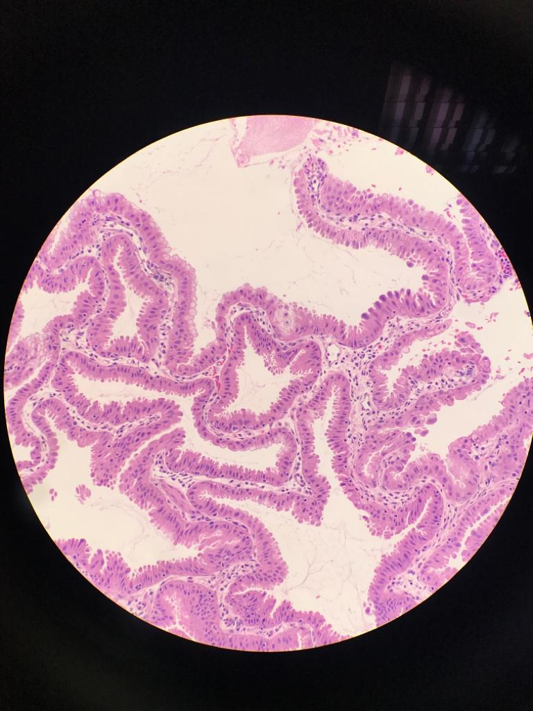 mcamarajurado's tweet photo. Have you ever seen this gallbladder epithelium? No gross lesion. It comes from a liver donor. Thankss! #gipath #pathology @DraEosina @tralimiguel @liverpath @ariella8 https://t.co/QZHtr0bVWu