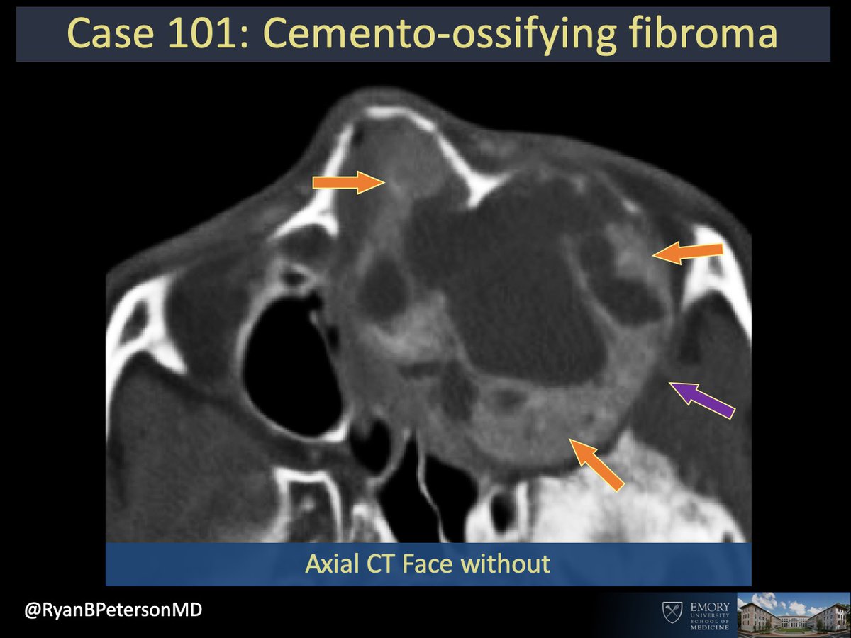 RyanBPetersonMD's tweet photo. @EmoryRadiology @TheASNR @ASHNRSociety @JudyGadde @nakoontz @JeffersonRads @IURadiology @CincyPedsNeuro @The_ASPNR @gennadanna Answer: Cemento-ossifying fibroma
Hard differential case that I had during training. Kind of has the ABC layering cystic stuff but ground glass matrix like fibrous dysplasia & enhances like stink.
#HNrad or #ENTrad's- have any other on differential or comments?
#EmoryRadCOTD https://t.co/EjUxtUezH3