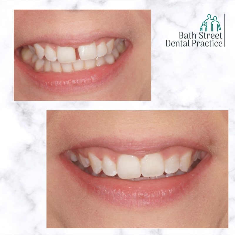 We had the pleasure of completing the final stages of this fantastic patient’s treatment today. She first came to us saying that she was unhappy with the appearance of her upper incisors, treated with #InmanAligner and #ClearAligners #abingdon #dentist #oxfordshire