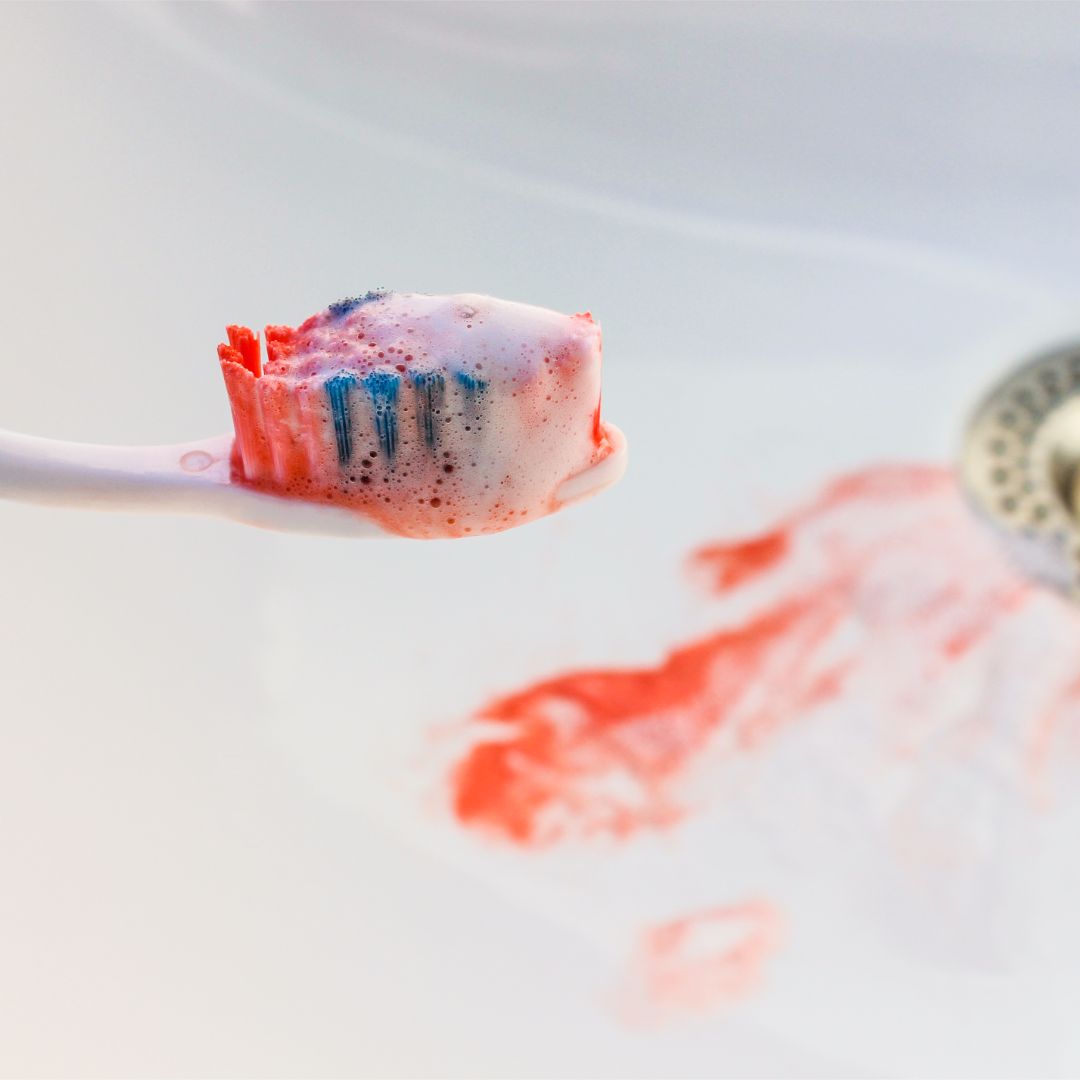 DentalCedar's tweet image. Don’t ignore your bleeding gums! Gingivitis is usually a painless condition and bleeding gums may be the only symptom. At this stage, gum disease can be treated and completely reversed.   #gingivitis #gumdisease