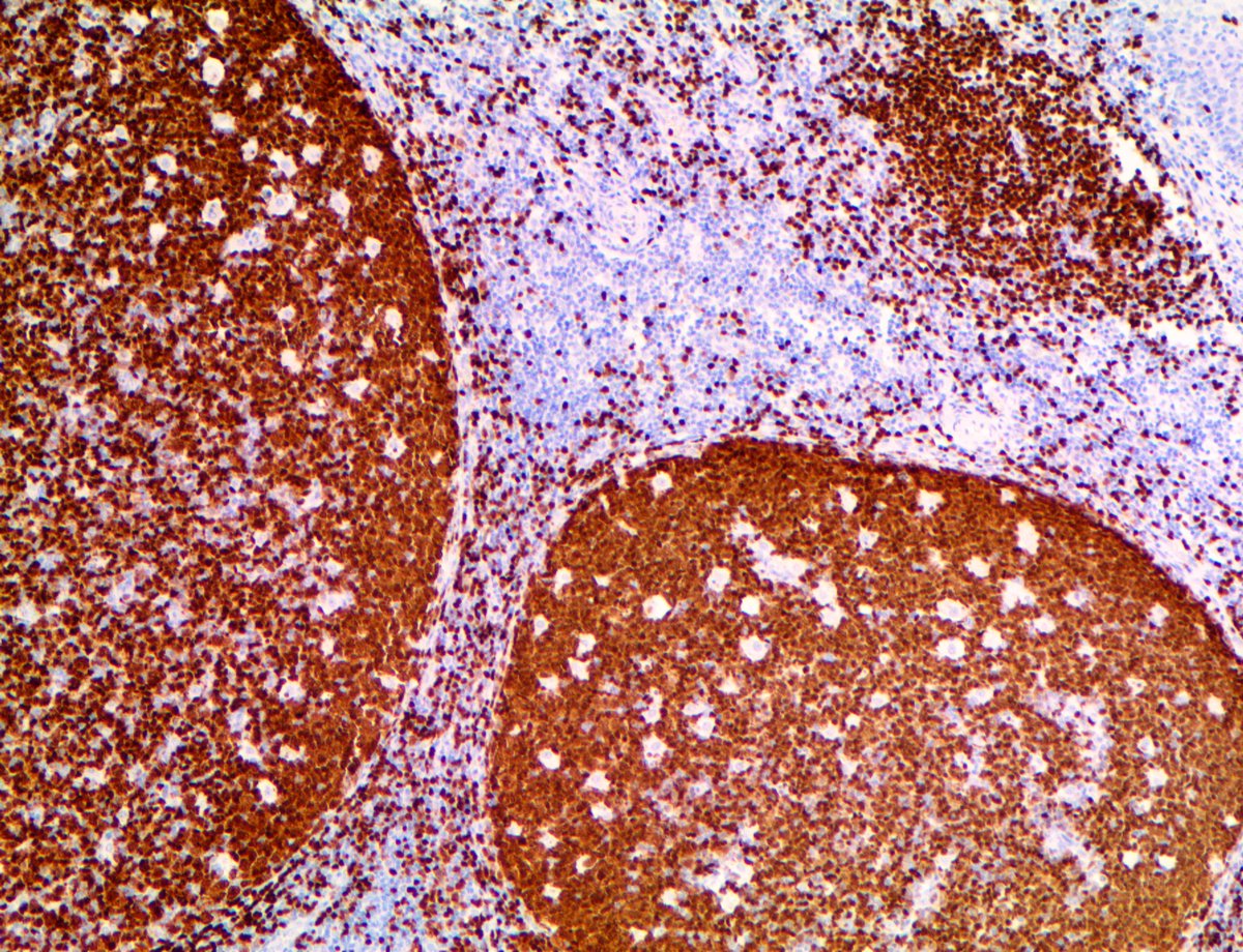 Bio_SB's tweet photo. Bio SB Photo Contest submission of our PAX-5, #RMab, on tonsil tissue. Great clarity in this signal! Submit your photos using one of our products and be entered to win $1000 in Bio SB credit! Submit here - https://t.co/UrWdJTXAlI
#pathology #pathart #pathlab #antibodies https://t.co/amNSfdCtr3