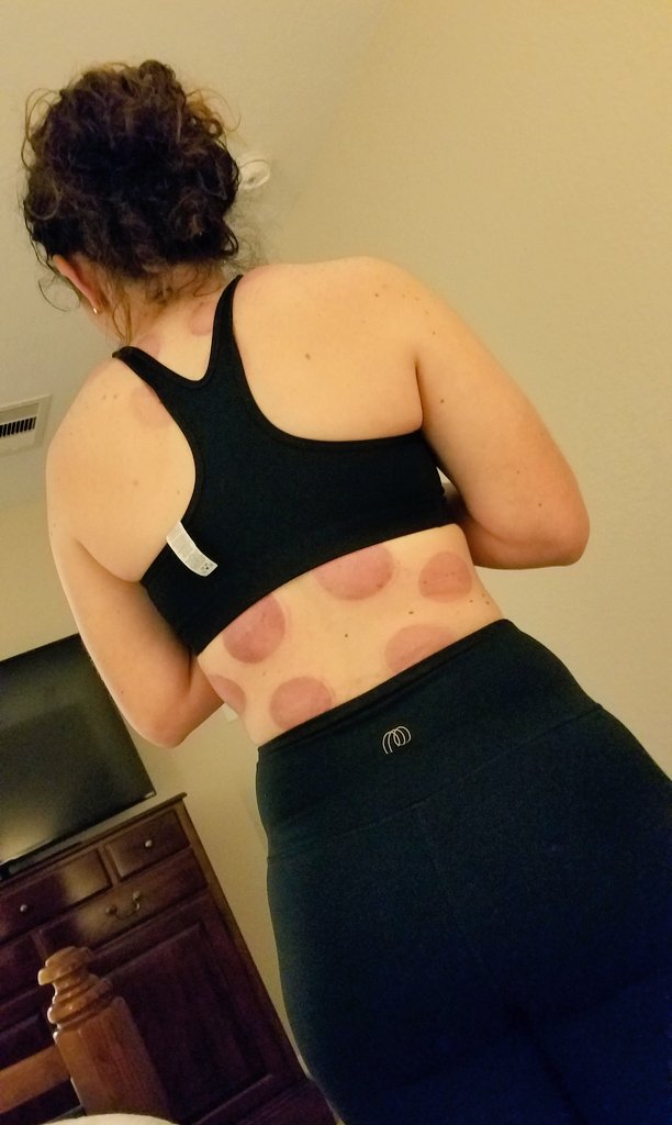 pilar_tatum's tweet image. Holy Cupping!  It looks awful but she has so much relief.  Last time she had this done, a counselor pulled her in to his office to ask her if she was being abused.  She said, "No Sir, I play softball".   #softballproblems