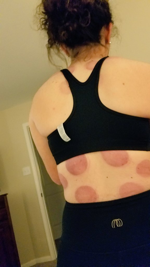 pilar_tatum's tweet image. Holy Cupping!  It looks awful but she has so much relief.  Last time she had this done, a counselor pulled her in to his office to ask her if she was being abused.  She said, "No Sir, I play softball".   #softballproblems