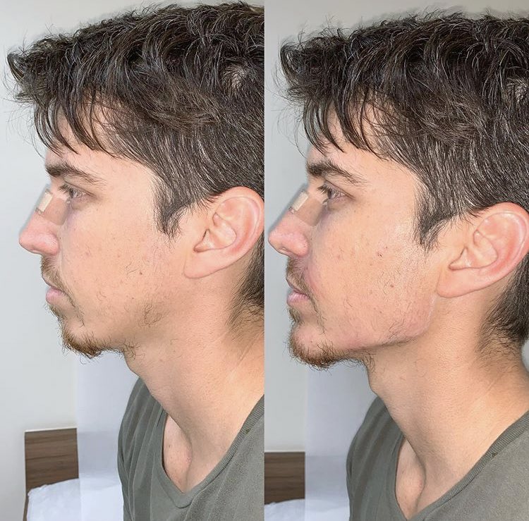 Estetik Facts Pa Twitter Jawline Dolgusu Kadinlardan Cok Erkeklerin Tercih Ettigi Bir Medikal Estetik Olmus Yuvarlak Suratli Erkek Kalmadi
