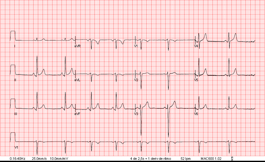 icorvilud's tweet photo. Mujer 38 años; deportista habitual (entrenamiento reglado con entrenador experimentado). Asintomática. La envían por alteración #electrocardiográfica.
#LeccionesECG
#ECGcorner #PPS #preparticipacion #cardiologiadeportiva #sportscardiology #sportscardio https://t.co/JsQcok8EeX