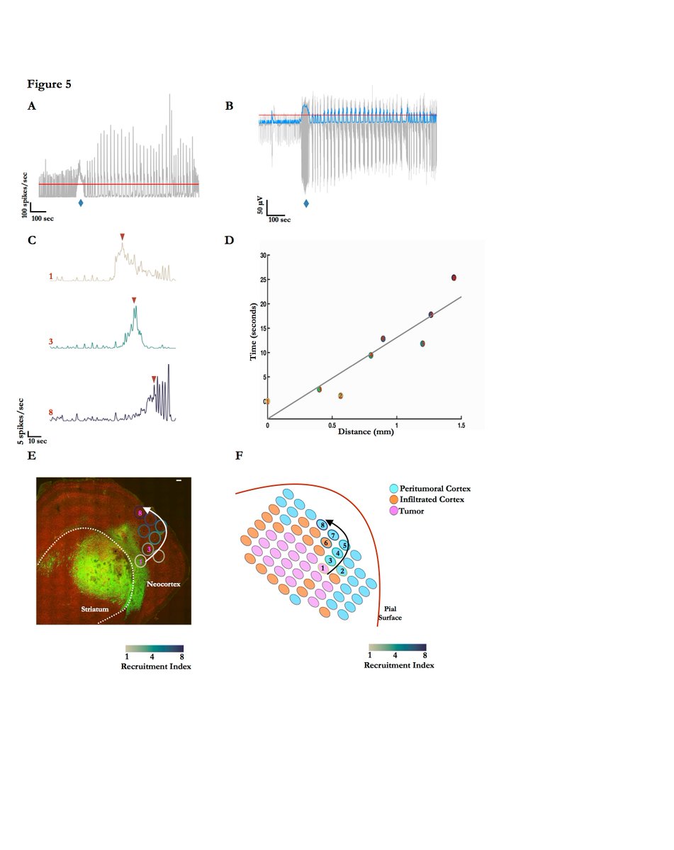Our new study showing how seizures spread in the setting of #glioma. Thanks to the whole team at the Bartoli Brain Tumor Lab, as well as <a href="/NREF/">act</a> and @AES for funding the work.
doi.org/10.1016/j.nbd.…