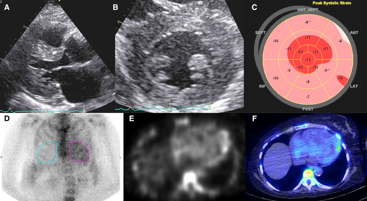 ✳️Great case on false positive PYP scan and Target sign on strain echo imaging
'Hydroxychloroquine-Mediated Cardiotoxicity With a False-Positive 99mTechnetium–Labeled Pyrophosphate Scan for Transthyretin-Related Cardiac Amyloidosis'
ahajournals.org/doi/10.1161/CI…