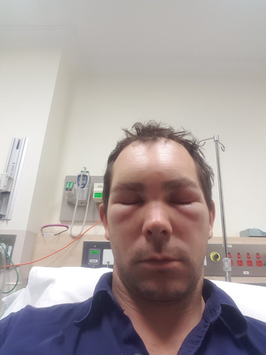 shakes1891's tweet photo. @DanielAndrewsMP I'm just wondering why a junkie can get needle for free while i have to pay for Epipens to stay alive when a bee stings me. I'd love to hear your thoughts on the matter... #anaphylaxis https://t.co/jzJq6LmN67