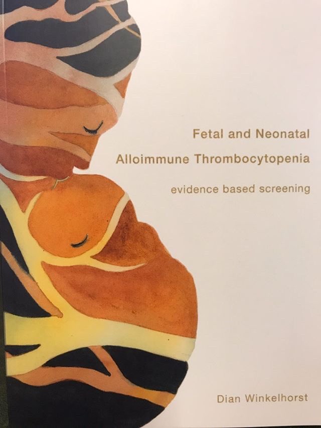 naitbabies's tweet photo. New publication #FNAIT ‘evidence based screening’ by Dian Winkelhorst #NAIT #ICH #medics #midwifery #epilepsy #BABIES #bleedingtodeath https://t.co/GtuOx6OpPL