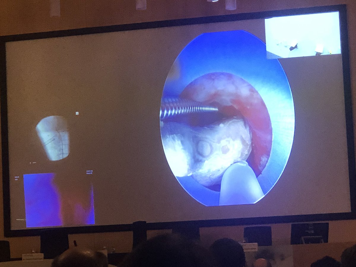 Giufrax's tweet photo. Amazing ECIRS surgery made by @scoffonecesare and @dperfen demonstrating how easy is to remove a blocked stone in the Perc N-Circle basket. Great control of this tool!! https://t.co/aVfPy0SAel