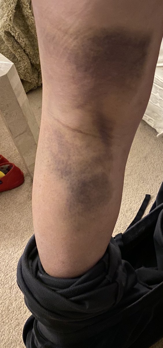 acerbicmiss's tweet photo. And that is what you call a sore swollen knee...at the back, goodness knows what the front will look like when the dressing is removed. Little wonder Iโm in so much pain ๐ซ#totalkneereplacement #swollen #feelingsore https://t.co/w1jeMYRRPo