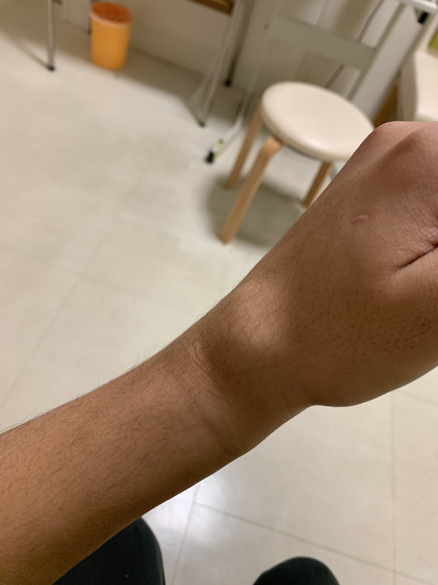 ナスノヒト 手首 粉砕骨折しました ナスノヒト 手首 粉砕骨折しました
