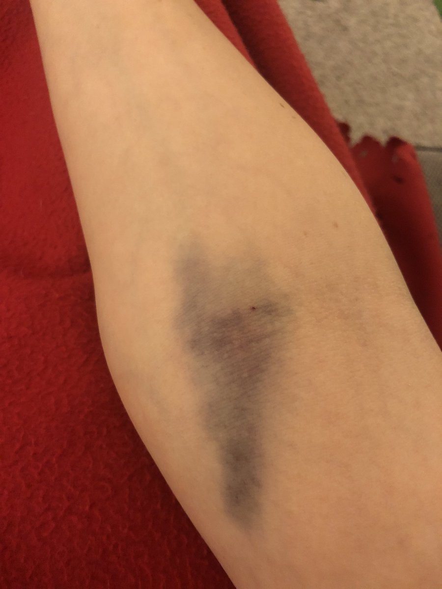 TheNuthatchNest's tweet image. 28 weeks: Blood Glucose Test. 🤦🏻‍♀️. #pregnancyproblems