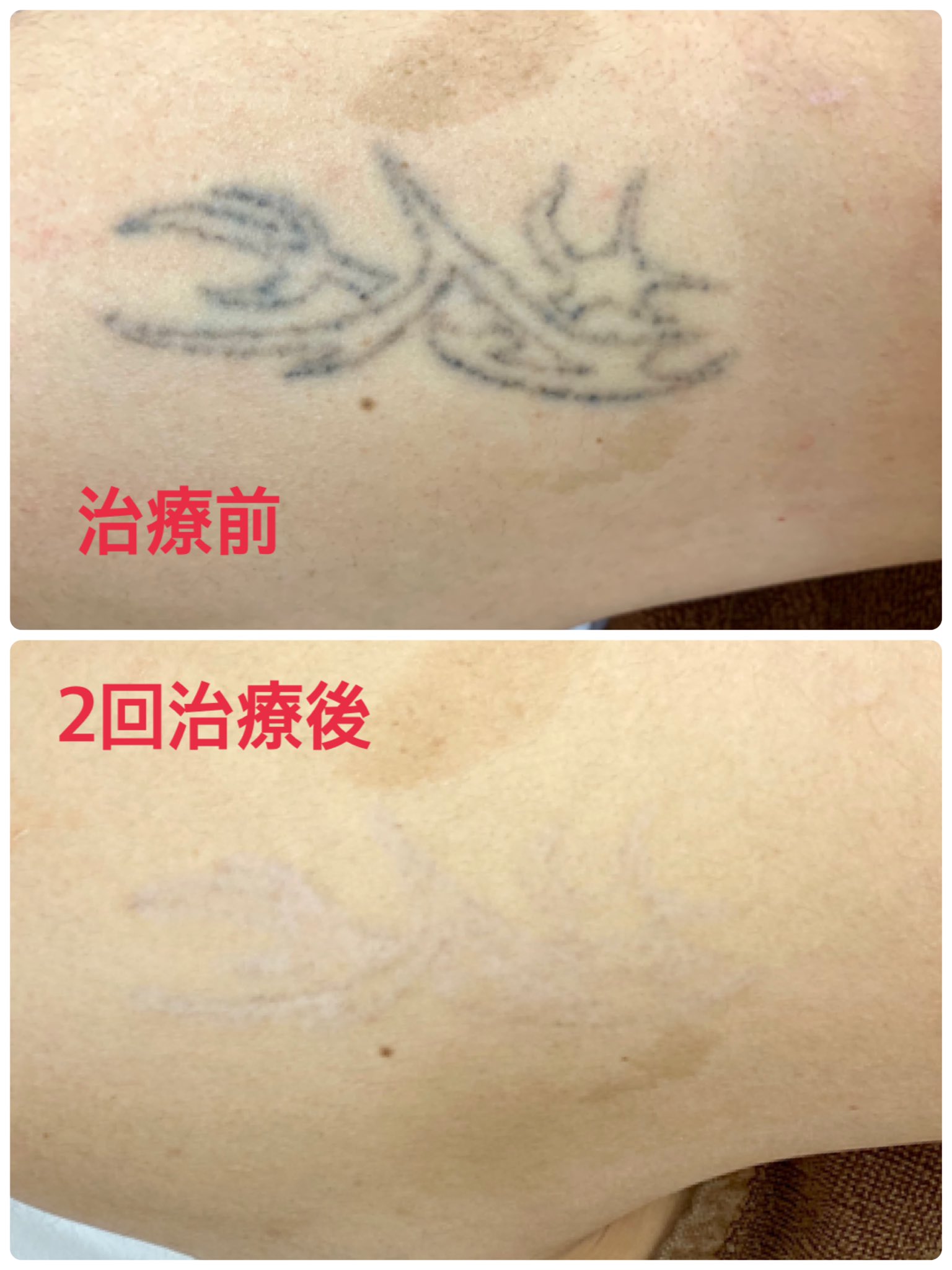 キルシェクリニック Dr めかた ピコレーザーで2回治療したら ほぼ消せました みんな早く消える と良いのですが なかなかうまくはいきません タトゥーが消えるかどうかは 入れた時点の色素の質 深さ 量で決まります タトゥーに悩まれたらいつでも
