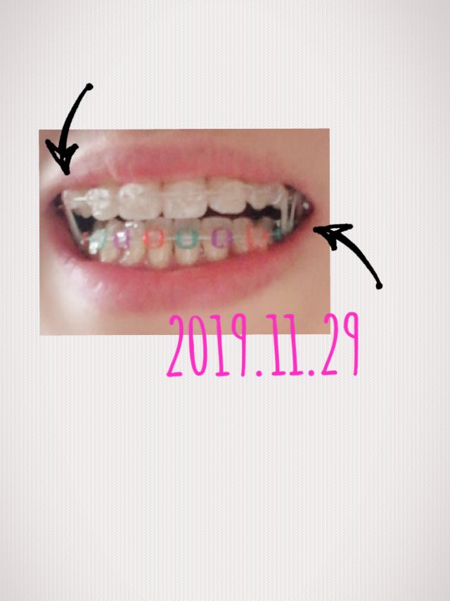 顎間ゴム Twitter Search