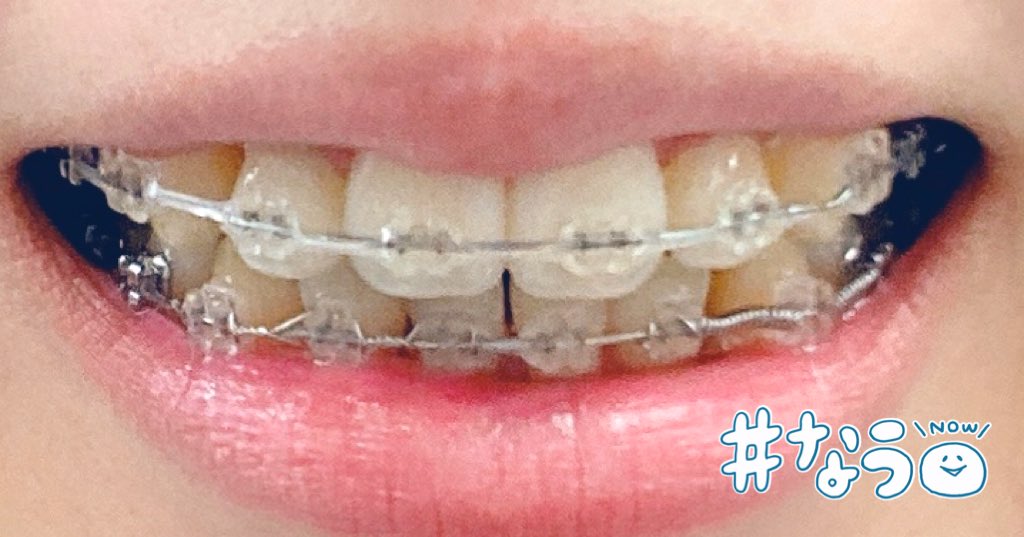 22回目の調整！
前歯のゴム掛け前後1ヶ月の変化です〜！
早く前歯下げたい