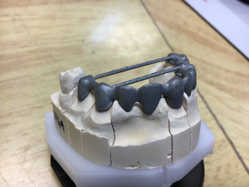 QualityCeramics's tweet photo. Someone once told me “That digital stuff won’t catch on” how wrong they were 😂😂 a couple from today’s workflow, 1 gold crown on 46, 2 10 unit bridge for ceramic bonding, slm Skillbond Digital from 3 Shape scan, beautiful passive fit straight onto model. @Skillbond https://t.co/gR2eYPRioa