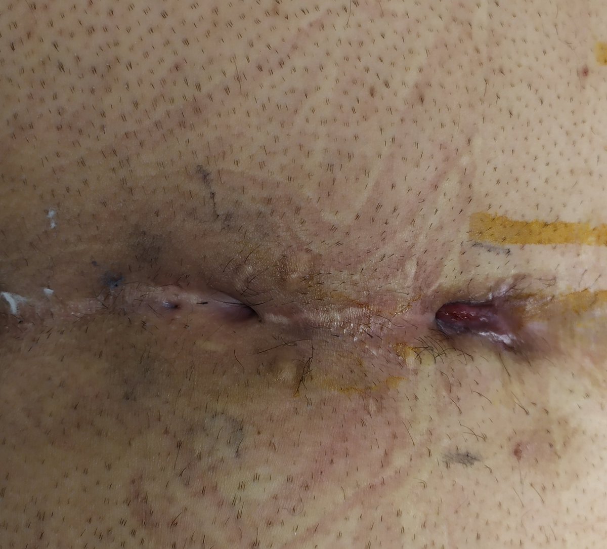 CantarellaDr's tweet photo. MIS for recurrent Pilonidal sinus.
Main indication IMO for fistuloscopy nowdays.
#Epsit #SoMe4Surgery #some4surgicaleducation
@ManishChandSurg @dr_samehhany81 @ZimNl @amirbastawrous @Gae_Gallo @YouESCP @YouSICCR https://t.co/uld7LJQMvz