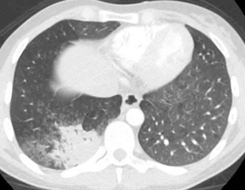 Here are the lung windows, showing pretty typical right lower lobe pneumonia. Does this change your thinking about the first image? Note that there is no interstitial edema in the RLL or pleural effusion.