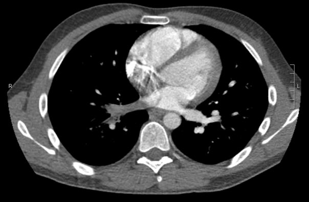 If report CT chest, this is an important entity to know about. This is a very good example of it. Not quite middle-aged male with chest pain and fever, no other medical history.What is your diagnosis?  #FOAMrad  #Radres  @JeffreyKanneMD  @CsFuss