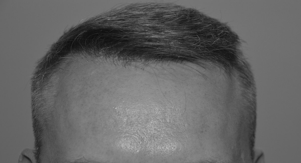 1234 follicular units / 2629 hairs transplanted in to a thinned forelock. #hairtransplantation #fue #belfast #malepatternhairloss