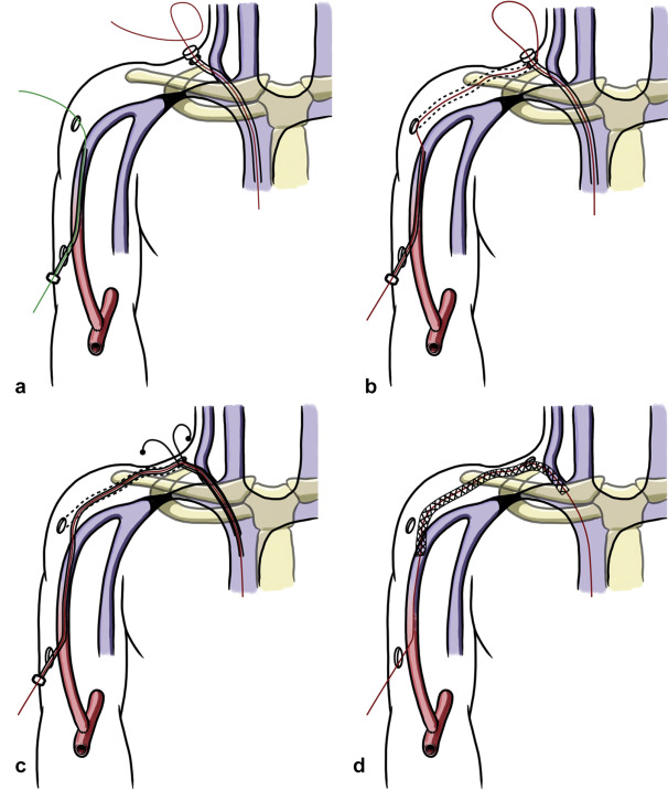 JVIR (@jvirmedia) on Twitter photo Percutaneous Costoclavicular Bypass for Thoracic Outlet Syndrome and Cephalic Arch Occlusion in Hemodialysis Patients | ow.ly/TRVe50wZjsv #irad <a href="/endoAVF/">Jeffrey Hull</a> Percutaneous Costoclavicular Bypass for Thoracic Outlet Syndrome and Cephalic Arch Occlusion in Hemodialysis Patients | ow.ly/TRVe50wZjsv #irad <a href="/endoAVF/">Jeffrey Hull</a>