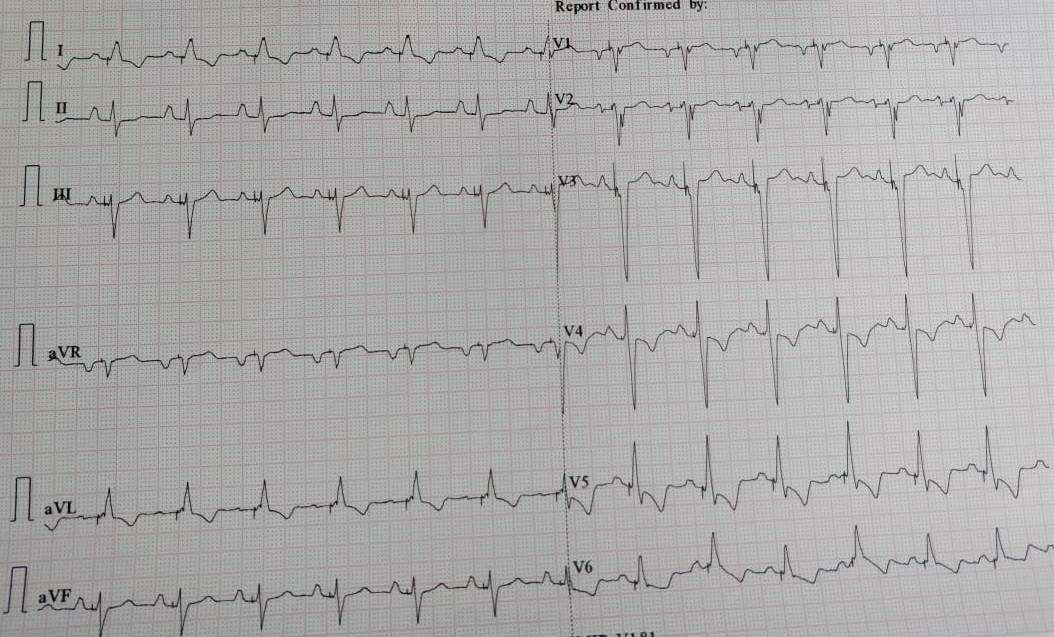 Left bundle branch pacing for LBBB with 2:1 AV block and mild LV dysfunction ; QRSD reduced from 160 msec to 118 msec; EF normalised at f/u