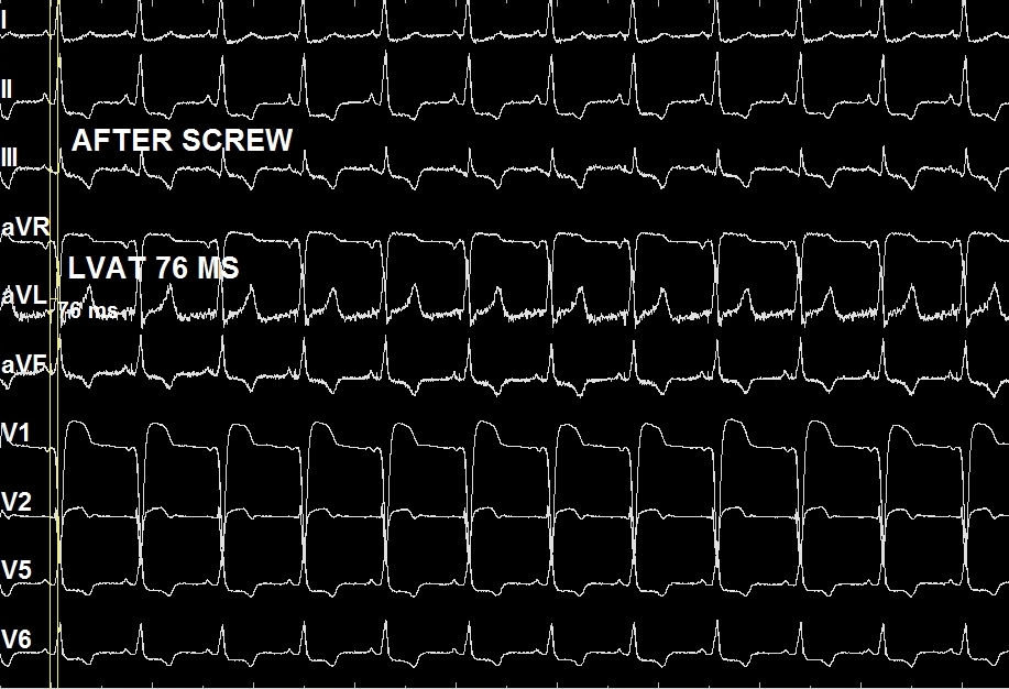 #pacenaturally LEFT BUNDLE BRANCH PACING for Non-ischemic Cardiomyopathy with severe LV Systolic dysfunction EF 30% and LBBB of QRSD of 160 ms and recurrent heart failure. LBBP improved LV function to 50% at 1.5 months f/u. QRSD post LBB pacing 117 msec. Threshold 0.5 v